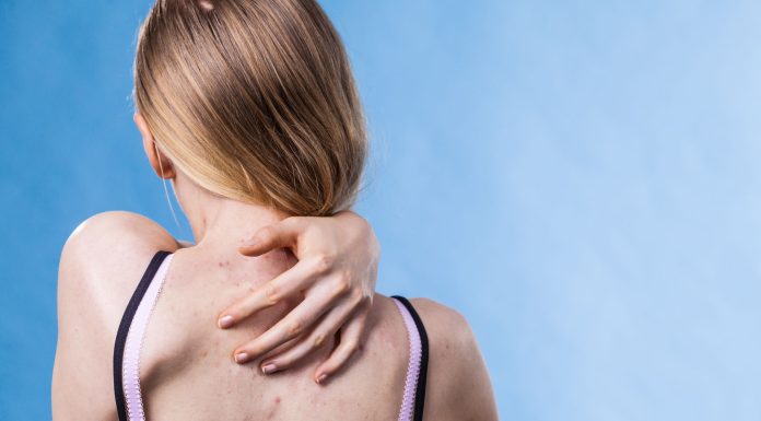 De ce apar cosuri pe spate?