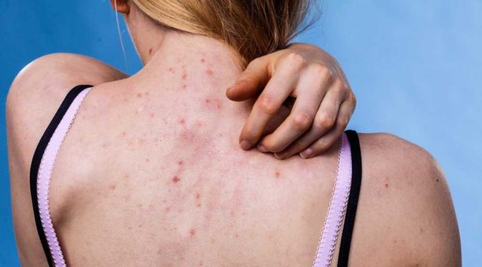 De ce apar cosuri pe spate?