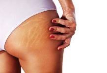 Cum se trateaza vergeturile rosii?