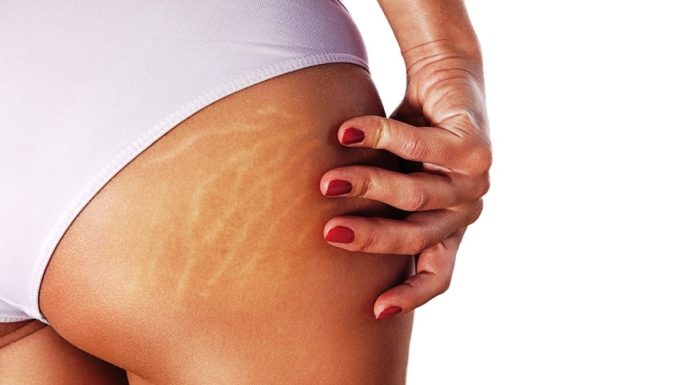 Cum se trateaza vergeturile rosii?