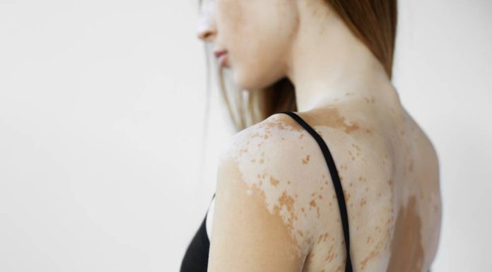 Ce este depigmentarea pielii?