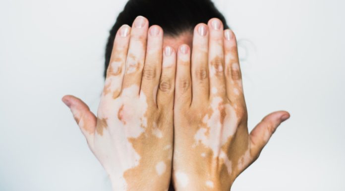 Ce este depigmentarea pielii?