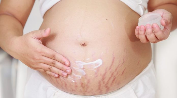 Cum se trateaza vergeturile rosii?